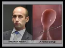 StevenMilerrectal polyp.webp