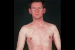 FCASCD_measles[1].webp